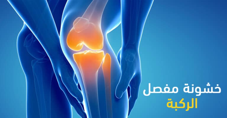 خشونة الركبة وعلاجها