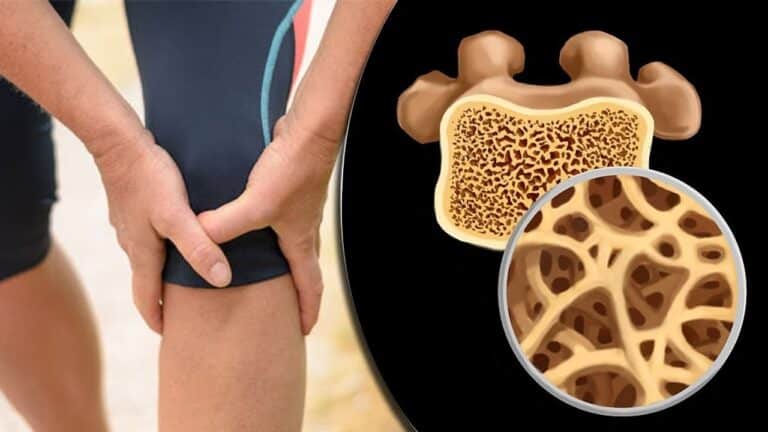 ماذا يأكل مريض هشاشة العظام؟