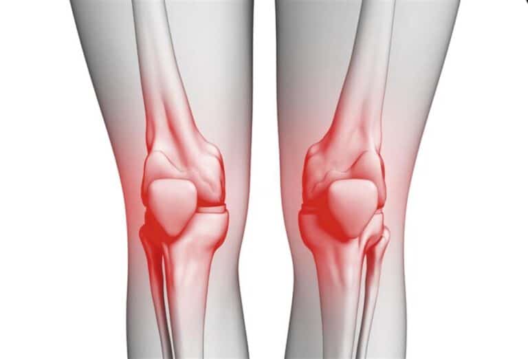 علاج التهاب مفاصل الركبة 1