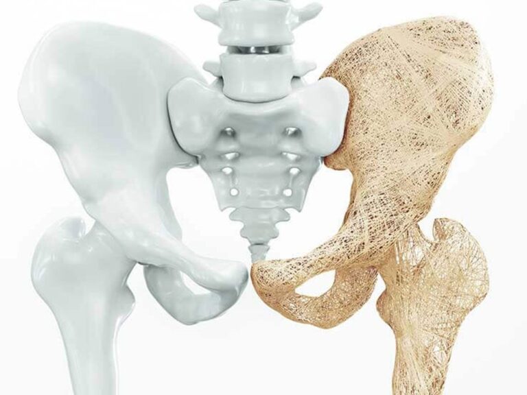 مرض هشاشة العظام