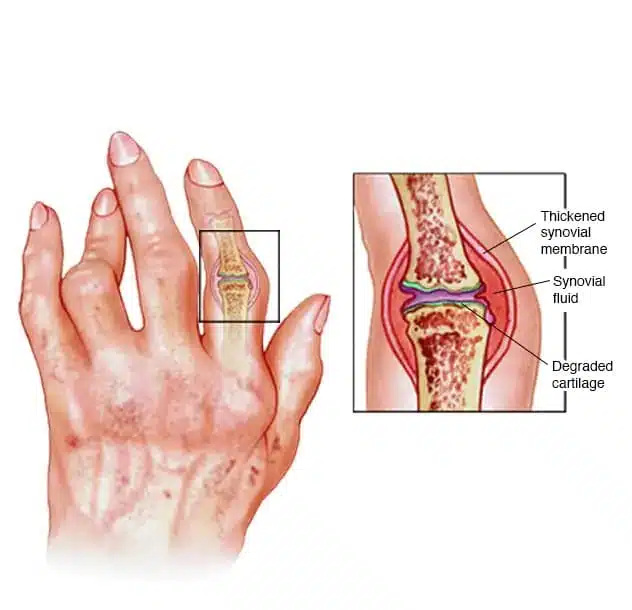 هل مرض الروماتويد خطير؟