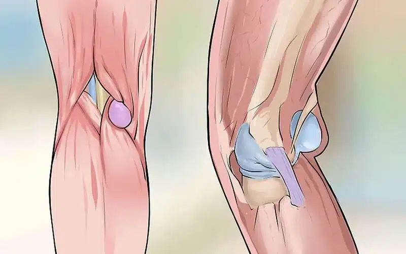 كيف يمكن الوقاية من التهاب الكيس الزلالي بالركبة؟