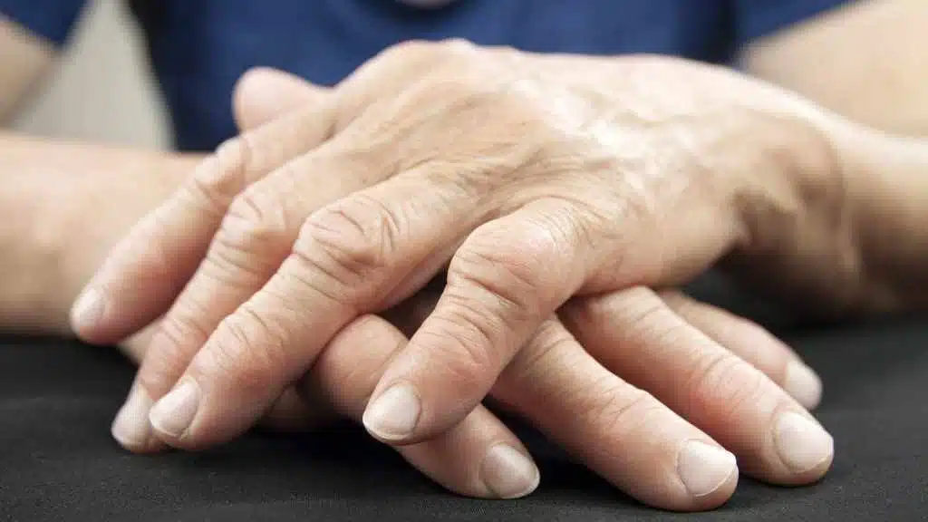 Close up of hands with rheumatoid arthritis 16x9 1024x576 1
