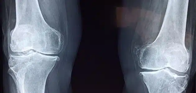 نصائح للوقاية من احتكاك العظام في الركبة