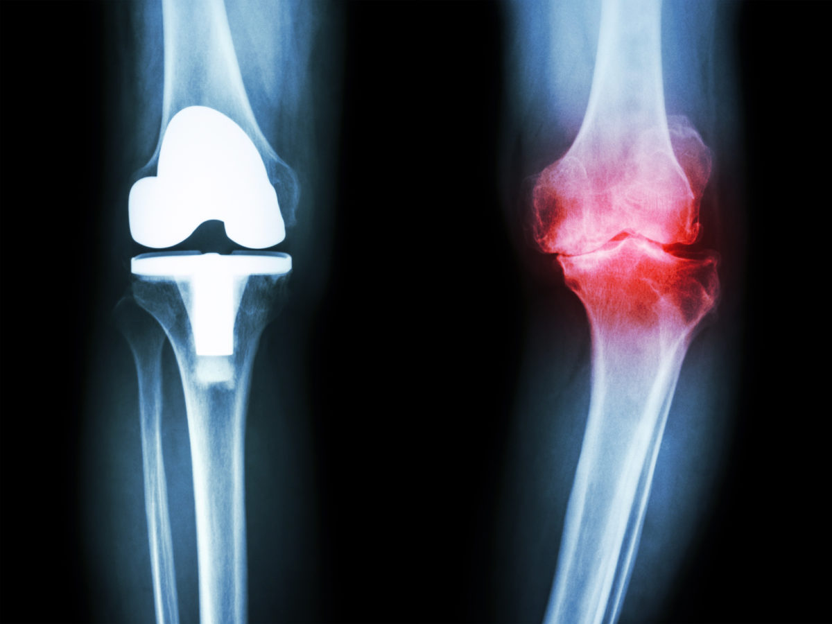 تعرف على درجات خشونة الركبة وما هي مضاعفاتها؟