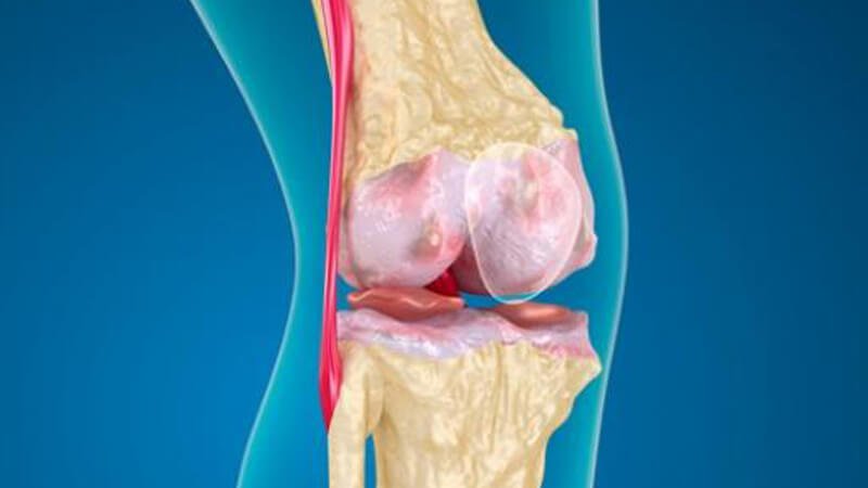 علاج تاكل غضاريف الركبة وهل يمكن علاجها بدون جراحة؟