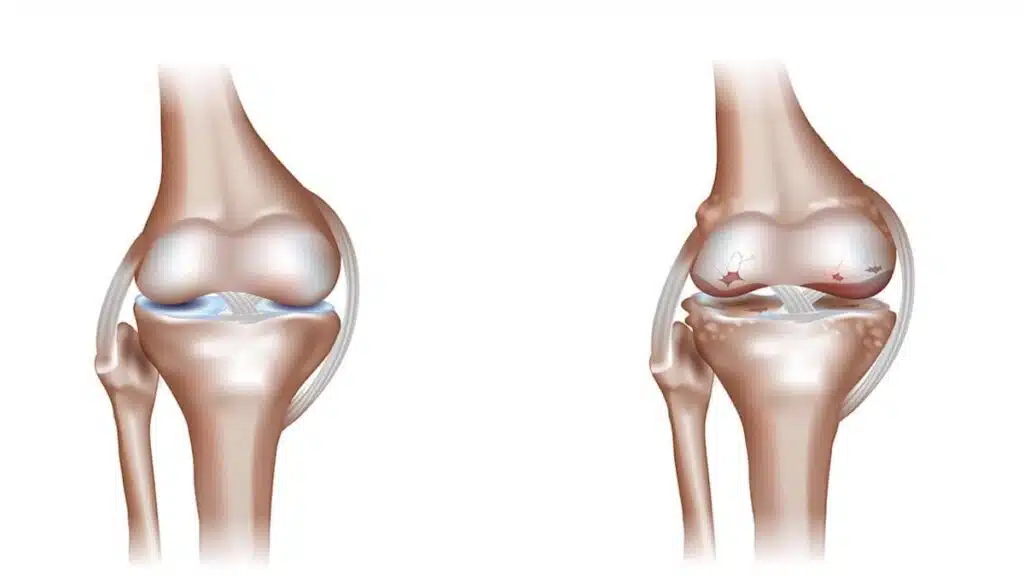 كيفية تشخيص خشونة الركبة