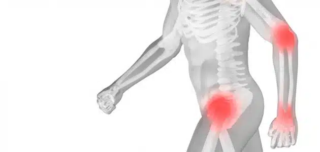 ما علاج هشاشة العظام