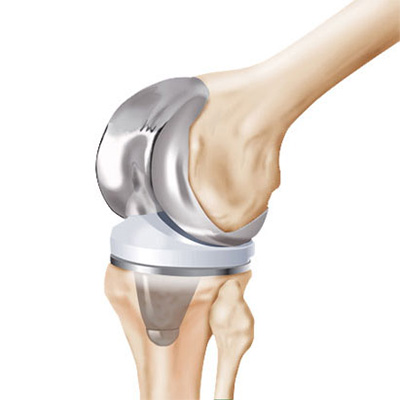 What are the causes of knee replacement surgery?