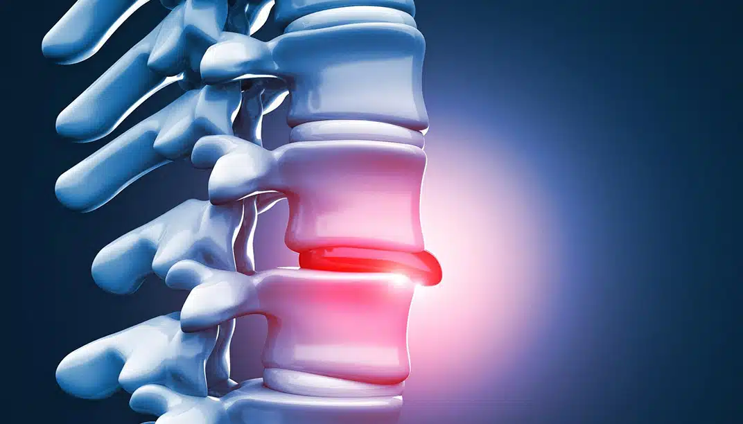 ما هو العلاج غير الجراحي للغضروف؟