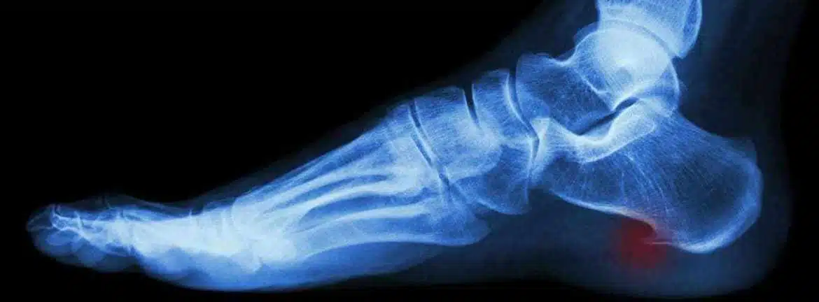 ما هي أسباب الشوكة العظمية؟