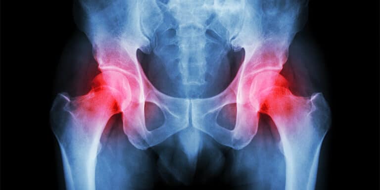 الم مفصل الحوض