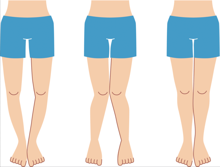 تقوس الساقين