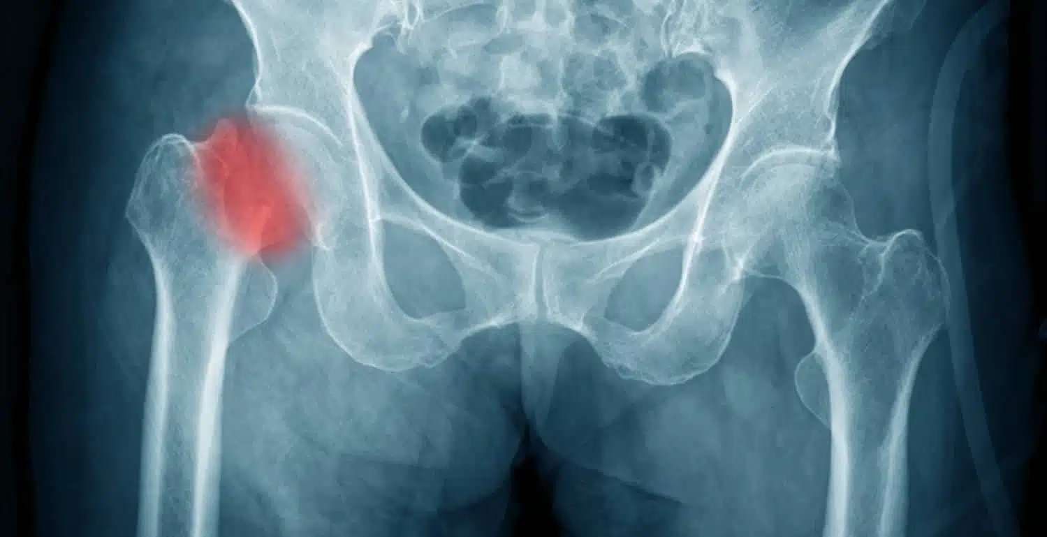 شرخ الحوض البسيط