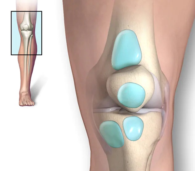 علاج الالتهاب الكيسي في الركبة وما هي أعراضه وأسبابه؟