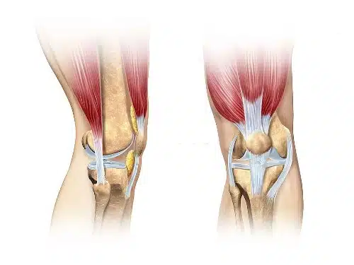 ما هي درجات تمزقات أربطة الركبة؟
