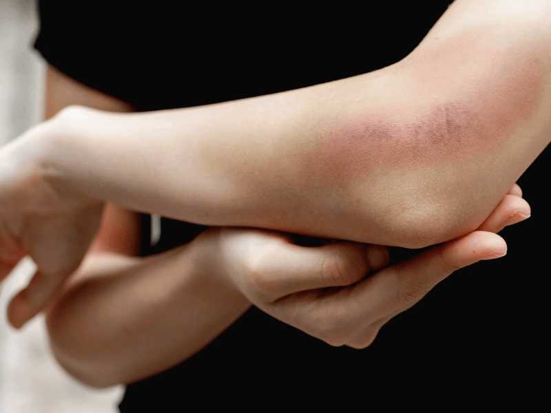 Foot bruises treatment