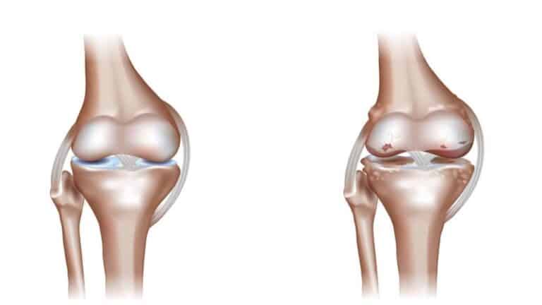 كيف اعرف اني مصاب بخشونة الركبة؟
