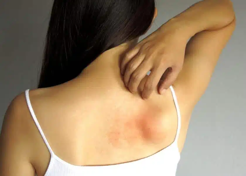 ما هي كدمات الظهر؟