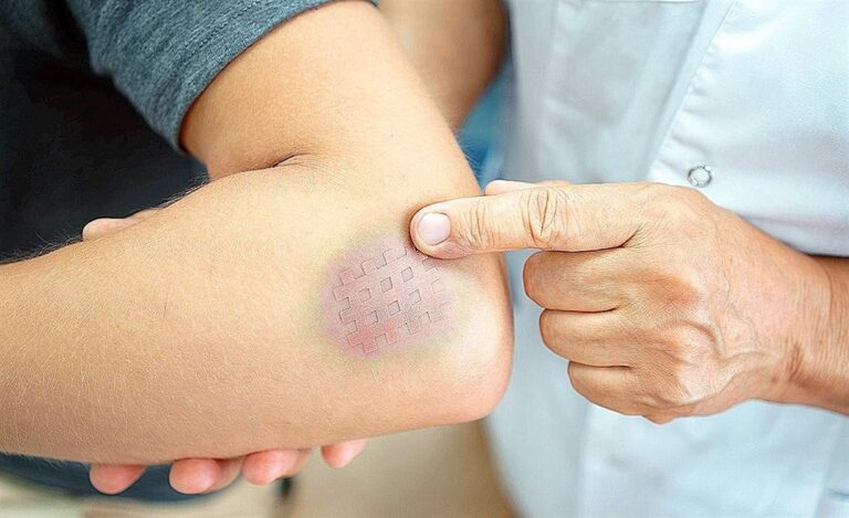 متى تختفي الكدمات؟