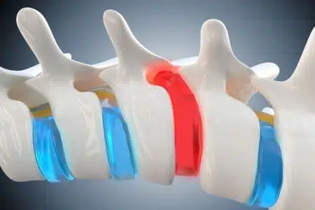 مدة الشفاء من عملية الانزلاق الغضروفي