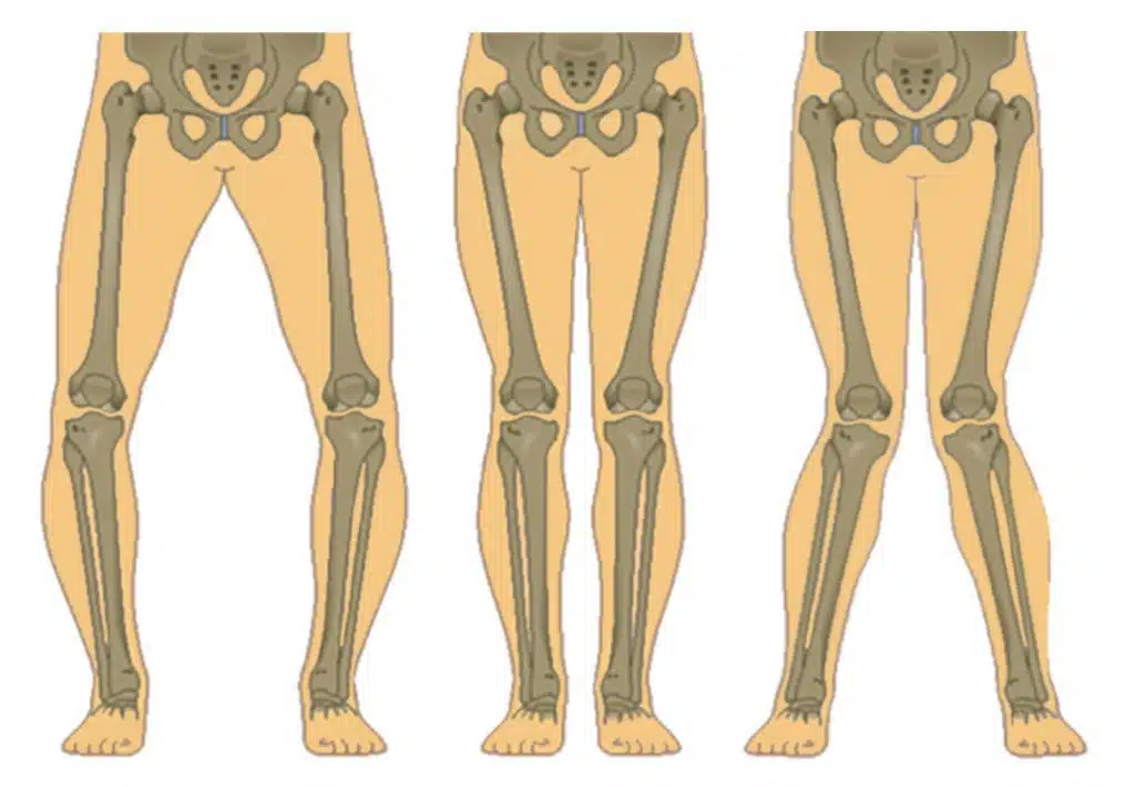 كم نسبة نجاح عملية تقوس الساقين؟