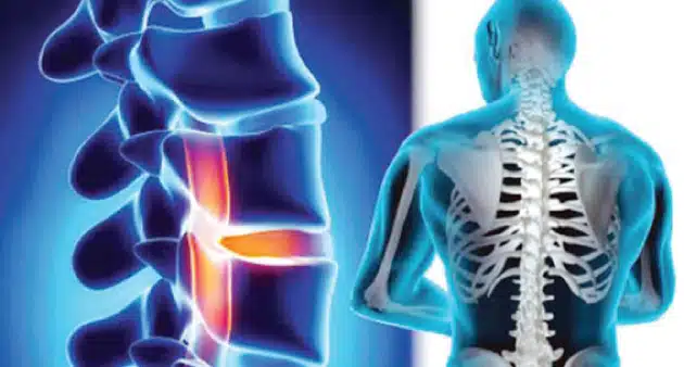 ما أعراض الانزلاق الغضروفي؟