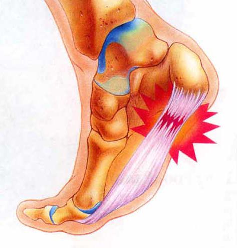 First advice for treatment of peroneal tendinitis
