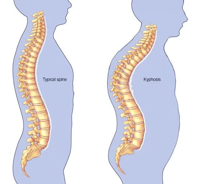 What are the causes of back curvature? And what are its symptoms?