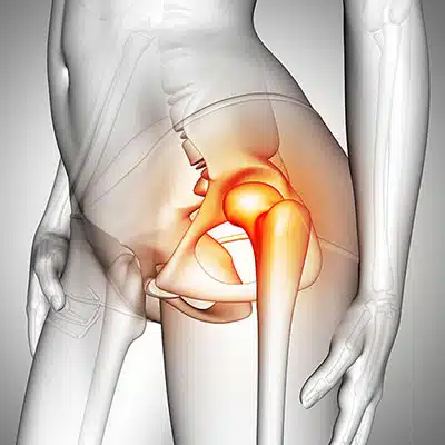 كيف تتم عملية تغيير مفصل الورك؟