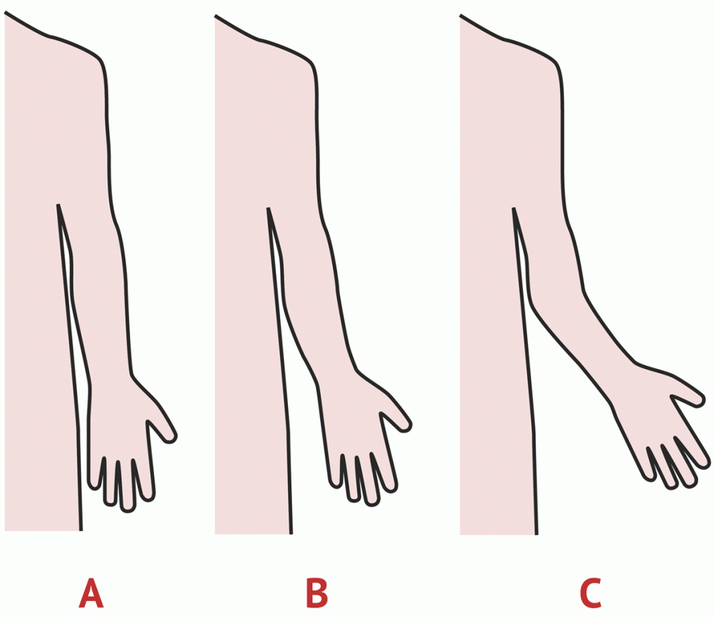 Carryingangle