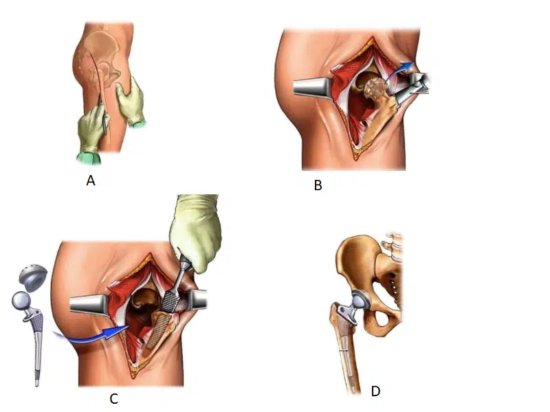 ما هي أنواع مفاصل الفخذ الصناعية
