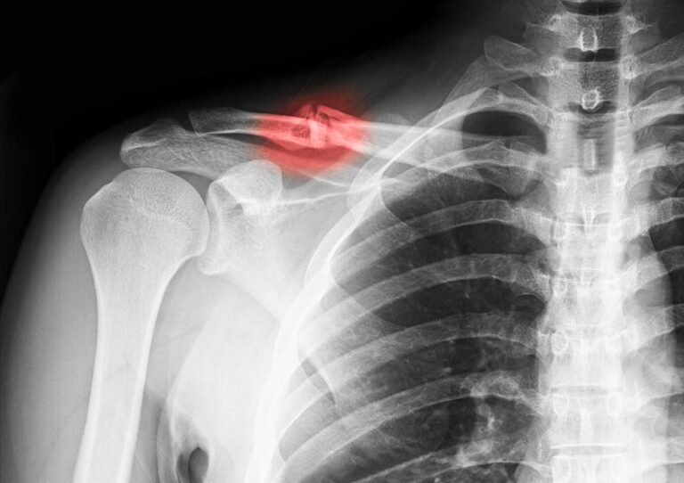 اضرار عملية الترقوة