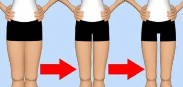 كيف اعرف اني عندي التصاق في الفخذين؟