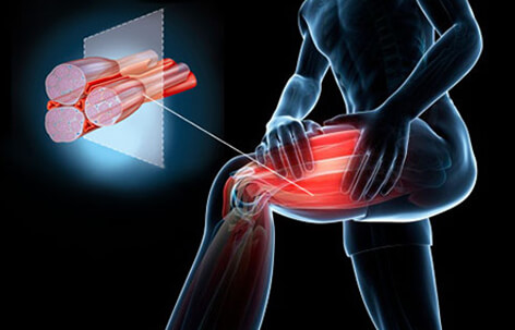 علاج التمزق العضلي في الفخذ وما هو علاج تمزق اربطة القدم؟