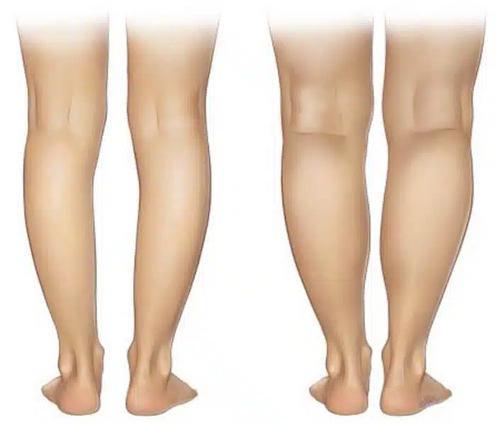 ما هي أعراض تقوس الساقين؟