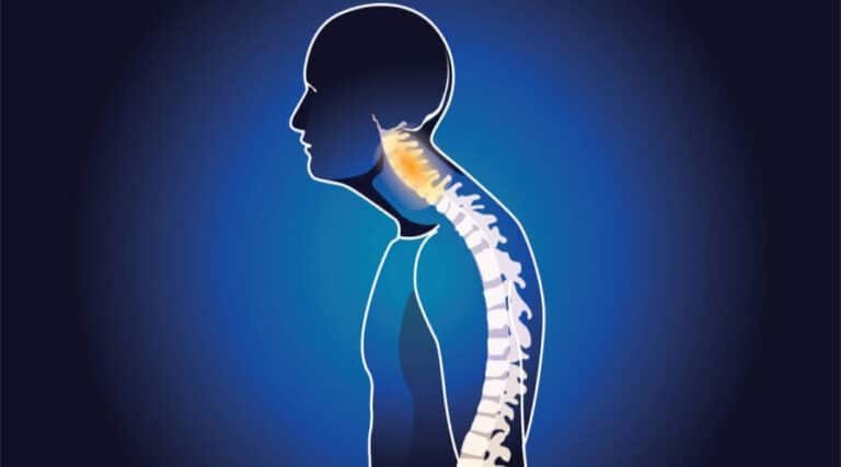 علاج تقوس الظهر بالعلاج الطبيعي 1