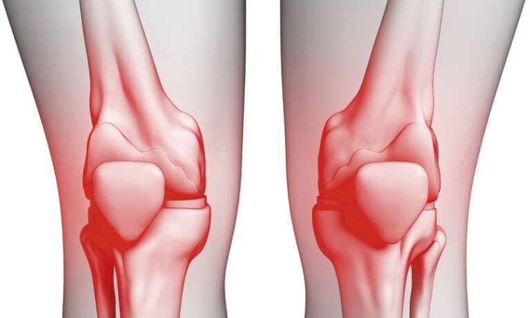علاج خشونة المفاصل