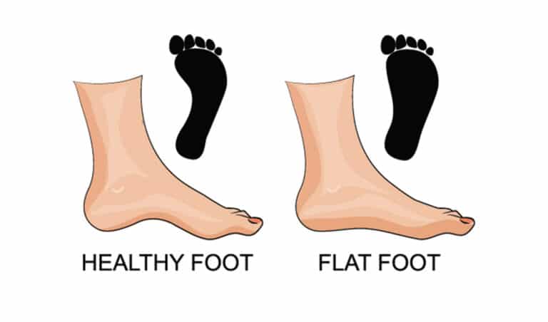 كم تكلفة عملية الفلات فوت في مصر