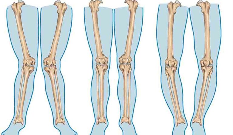 عملية تقوس الساقين