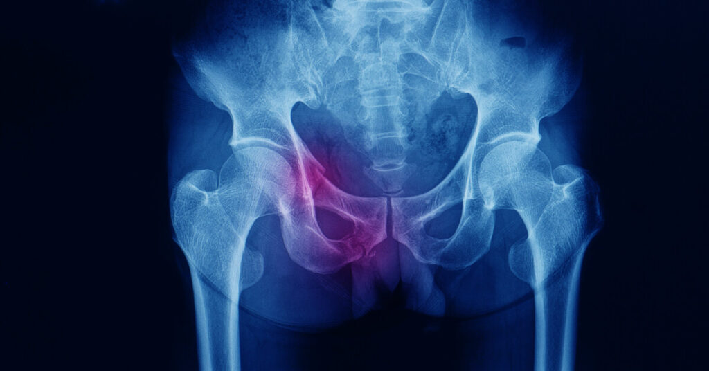 عملية كسر الحوض والعلاج الطبيعي بعدها