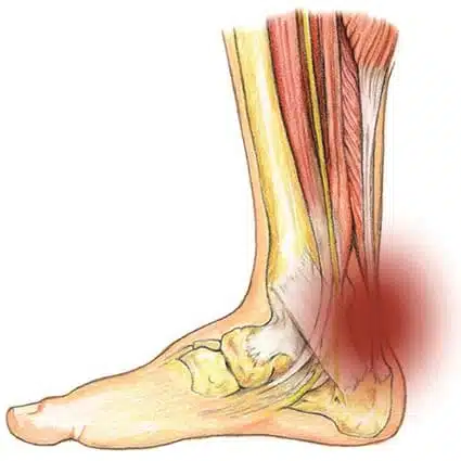 كم يستغرق علاج التهاب وتر اكيلس؟