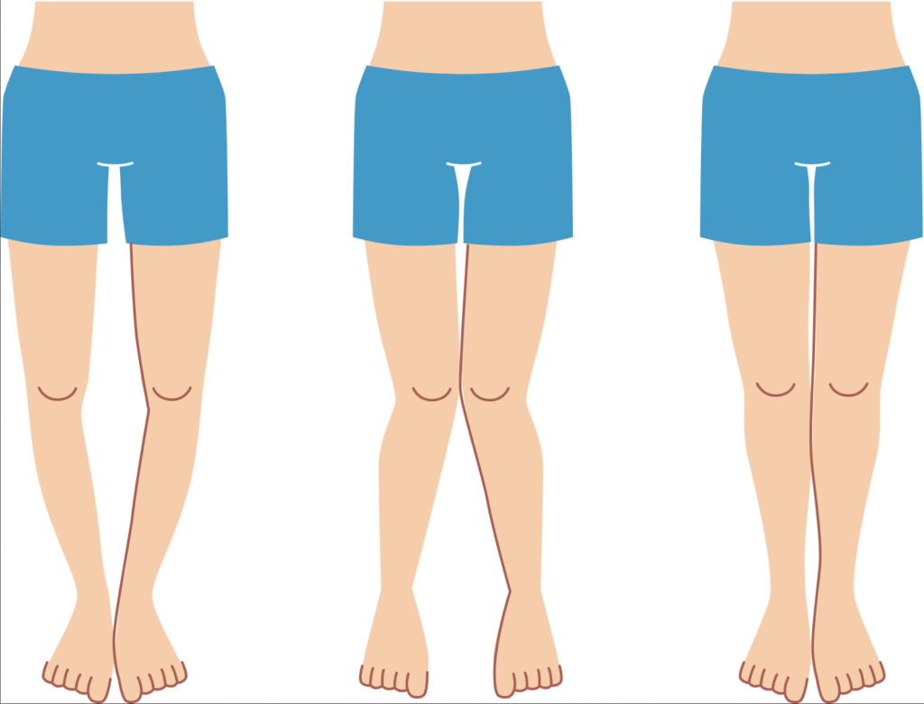 ما هو علاج تقوس الساقين؟