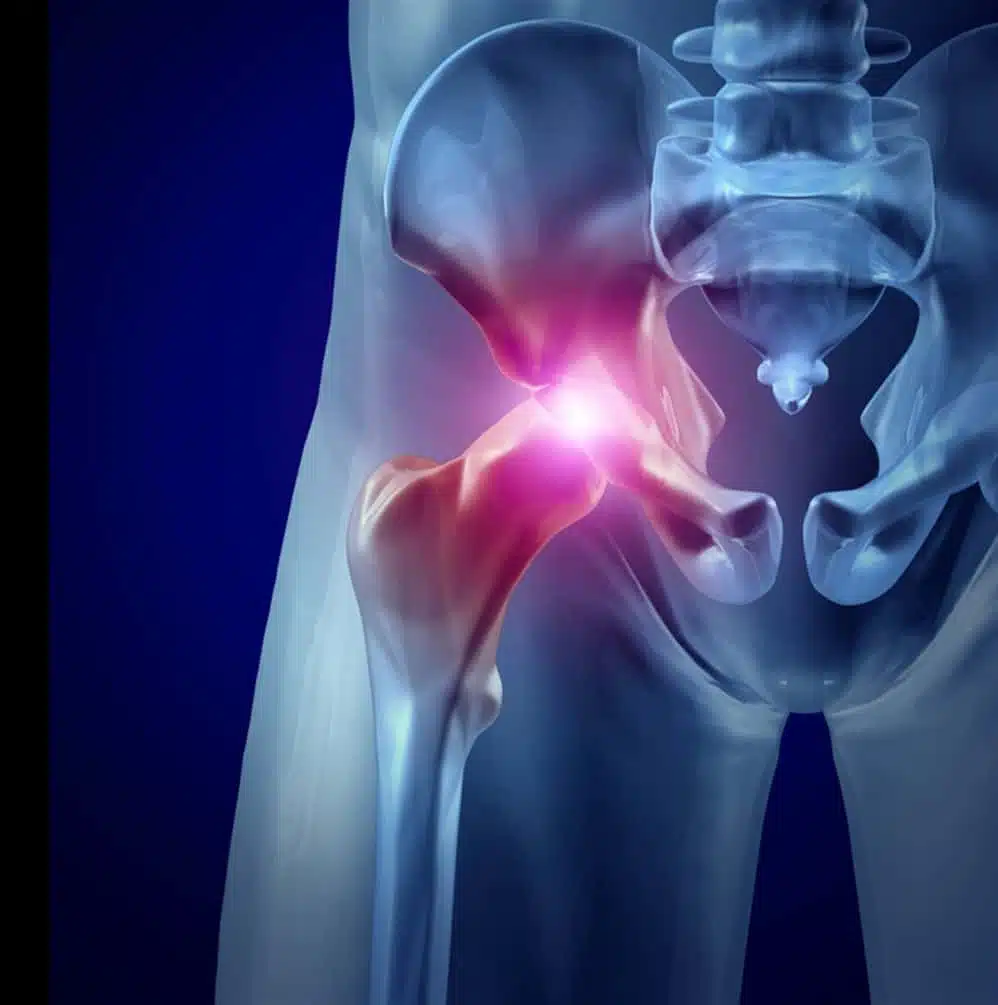 ما هي اعراض خشونة مفصل الحوض؟