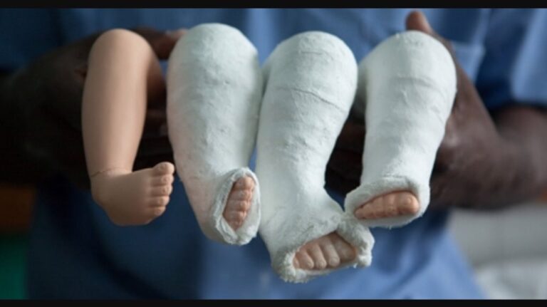 ما هي القدم المخلبية؟ 1