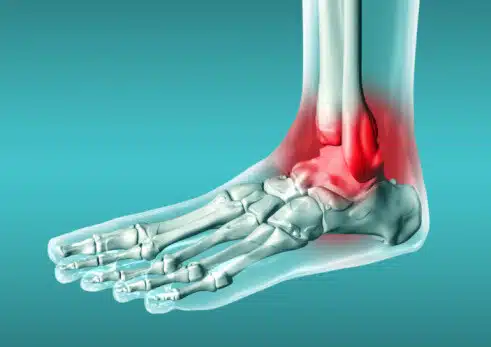 أسباب القيام بعملية تركيب الشرائح والمسامير في الكاحل