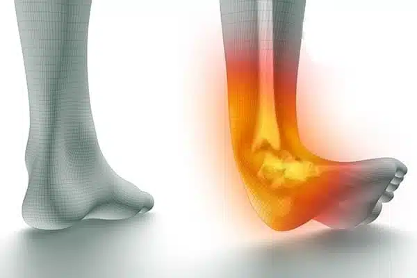 علاج التواء الكاحل وتمزق الأربطة