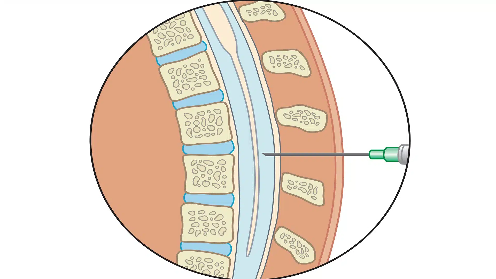 مضاعفات عملية البزل القطني