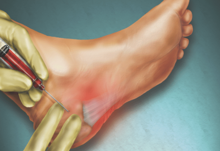 هل رياضة المشي مضرة لمرضى التهاب رابطة اللفافة الأخمصية؟