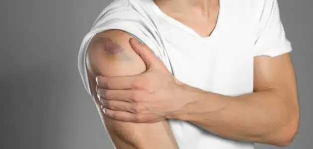 ما هو علاج الكدمات؟